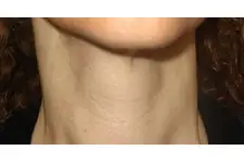 Primer Hipotiroidi Belirtileri Nelerdir? Primer Hipotiroidi Belirtileri Nelerdir?