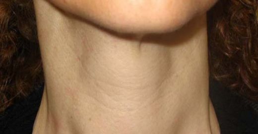 Primer Hipotiroidi Belirtileri Nelerdir?